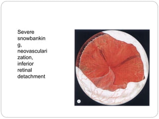 Severe
snowbankin
g,
neovasculari
zation,
inferior
retinal
detachment
 