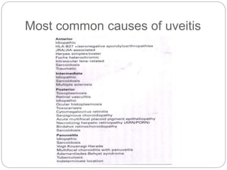 Most common causes of uveitis
 