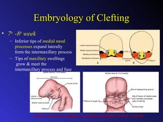 Clinical aspects of cleft lip & palate reconstruction | PPT