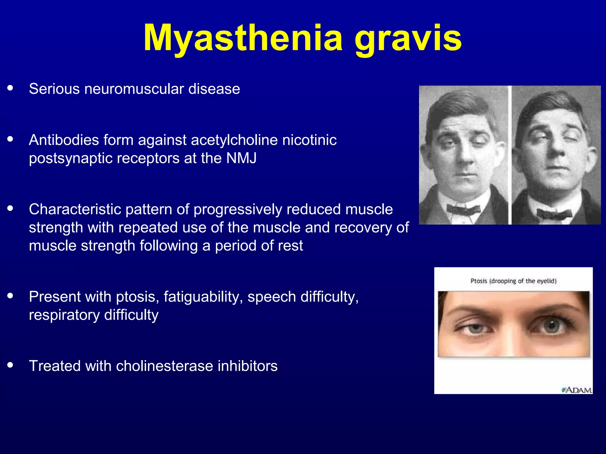 Myasthenia gravis 
• Serious neuromuscular disease 
• Antibodies form against acetylcholine nicotinic 
postsynaptic receptors at the NMJ 
• Characteristic pattern of progressively reduced muscle 
strength with repeated use of the muscle and recovery of 
muscle strength following a period of rest 
• Present with ptosis, fatiguability, speech difficulty, 
respiratory difficulty 
• Treated with cholinesterase inhibitors 
 