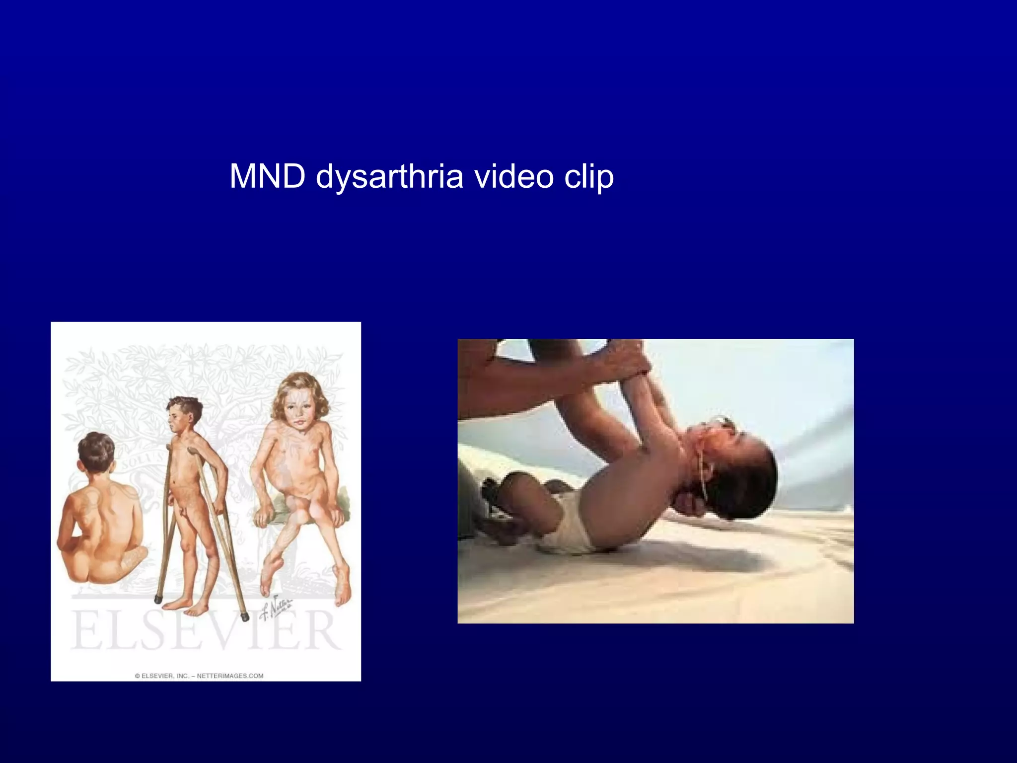 MND dysarthria video clip 
 