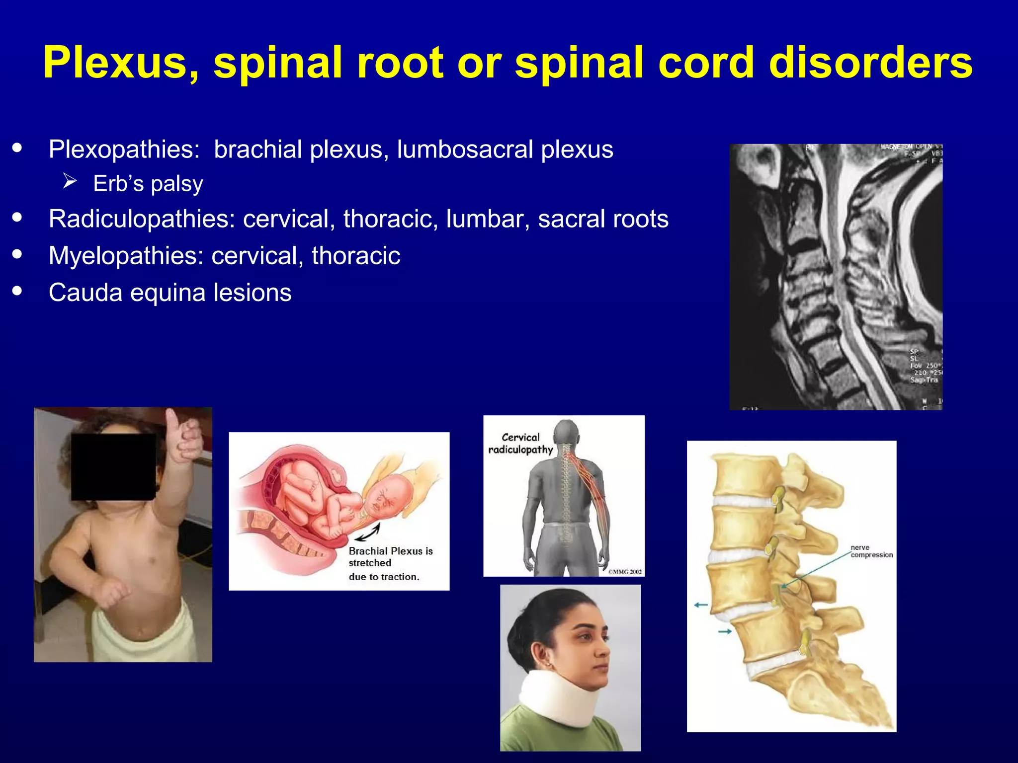 Plexus, spinal root or spinal cord disorders 
• Plexopathies: brachial plexus, lumbosacral plexus 
 Erb’s palsy 
• Radiculopathies: cervical, thoracic, lumbar, sacral roots 
• Myelopathies: cervical, thoracic 
• Cauda equina lesions 
 