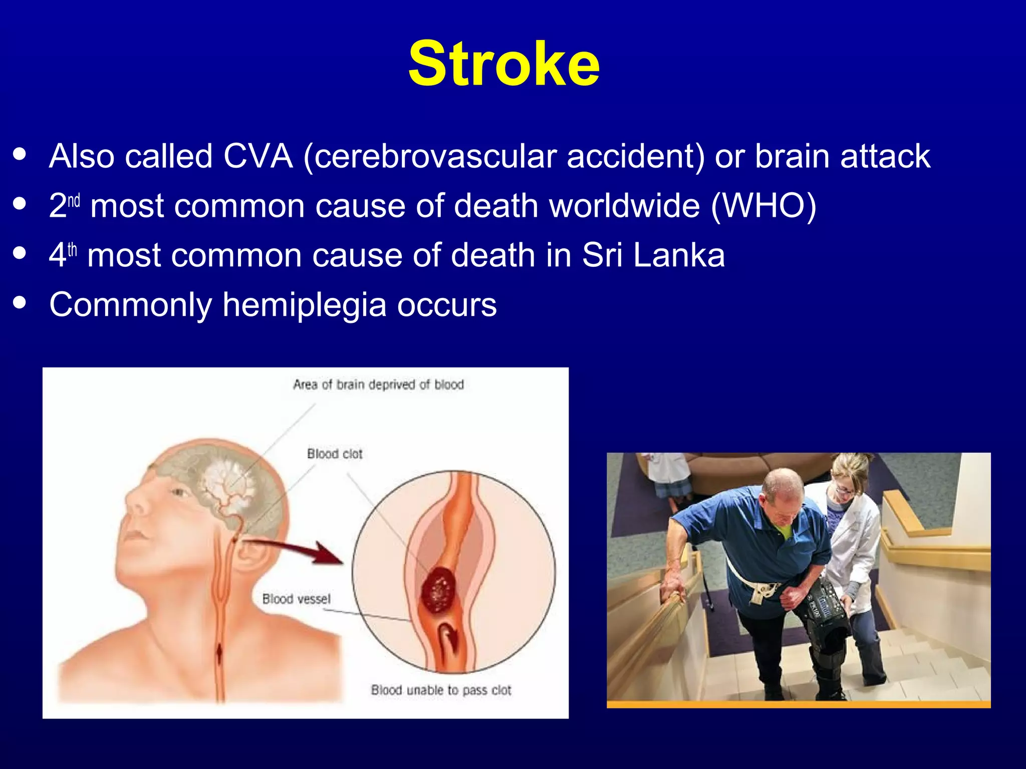 Stroke 
• Also called CVA (cerebrovascular accident) or brain attack 
• 2nd most common cause of death worldwide (WHO) 
• 4th most common cause of death in Sri Lanka 
• Commonly hemiplegia occurs 
 