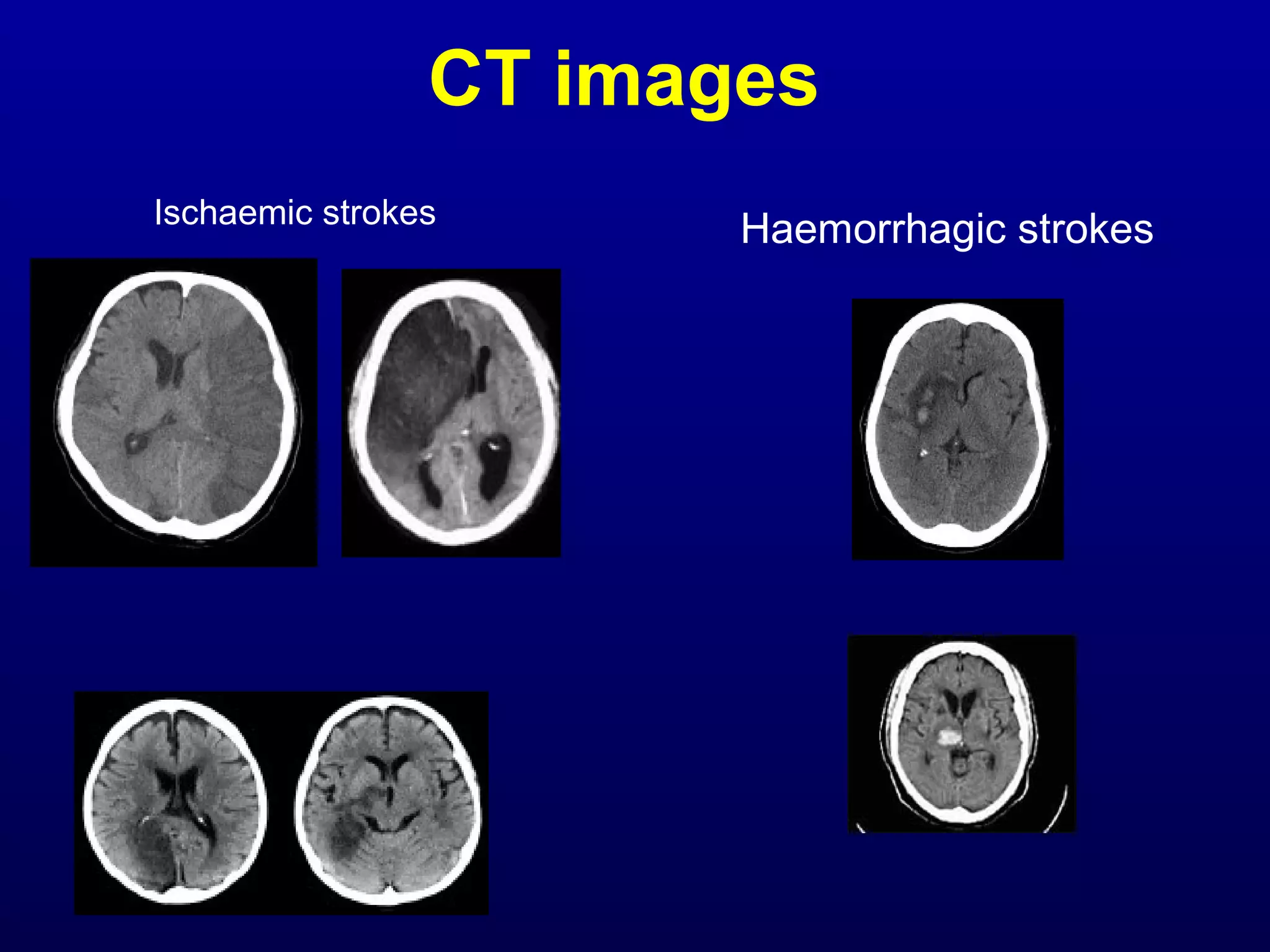 CT images 
Ischaemic strokes Haemorrhagic strokes 
 