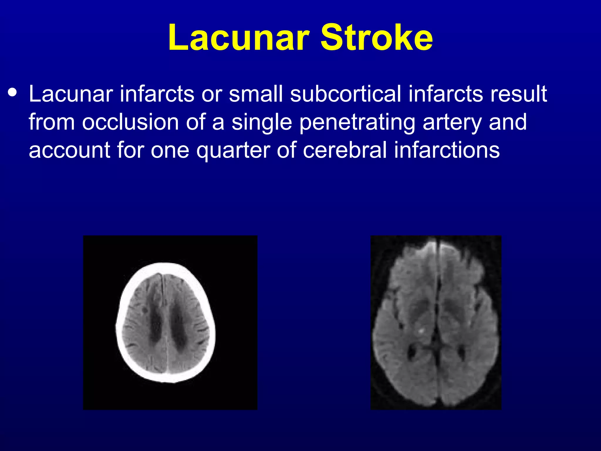 Lacunar Stroke 
• Lacunar infarcts or small subcortical infarcts result 
from occlusion of a single penetrating artery and 
account for one quarter of cerebral infarctions 
 