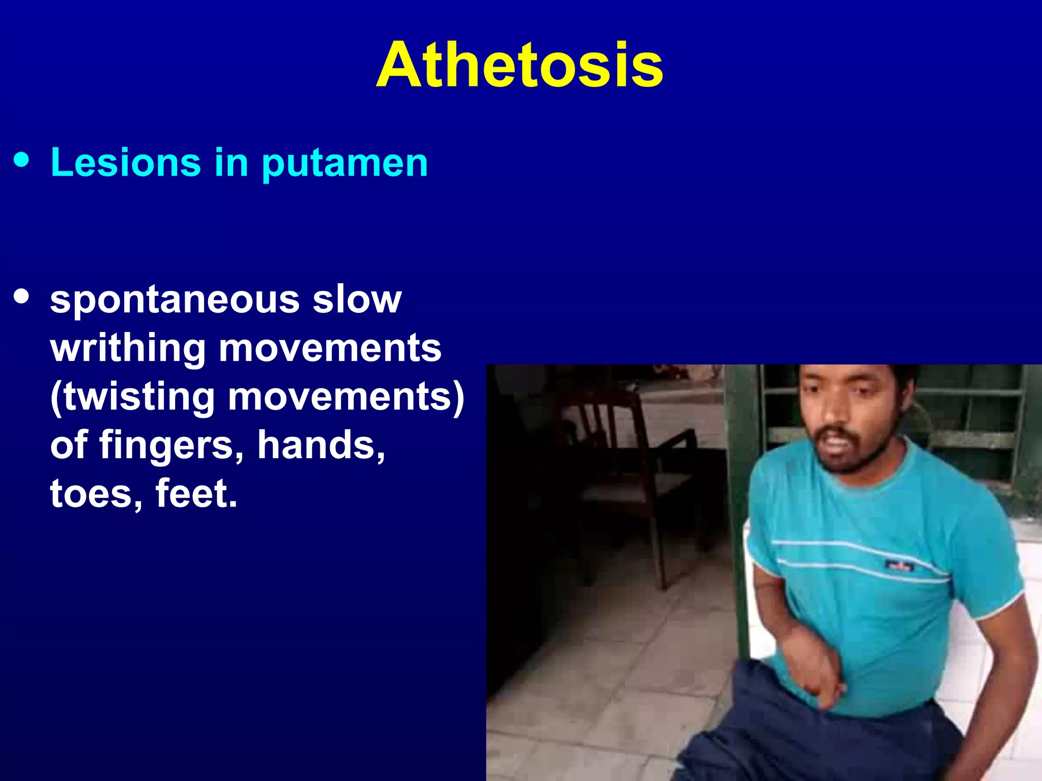 Athetosis 
• Lesions in putamen 
• spontaneous slow 
writhing movements 
(twisting movements) 
of fingers, hands, 
toes, feet. 
 
