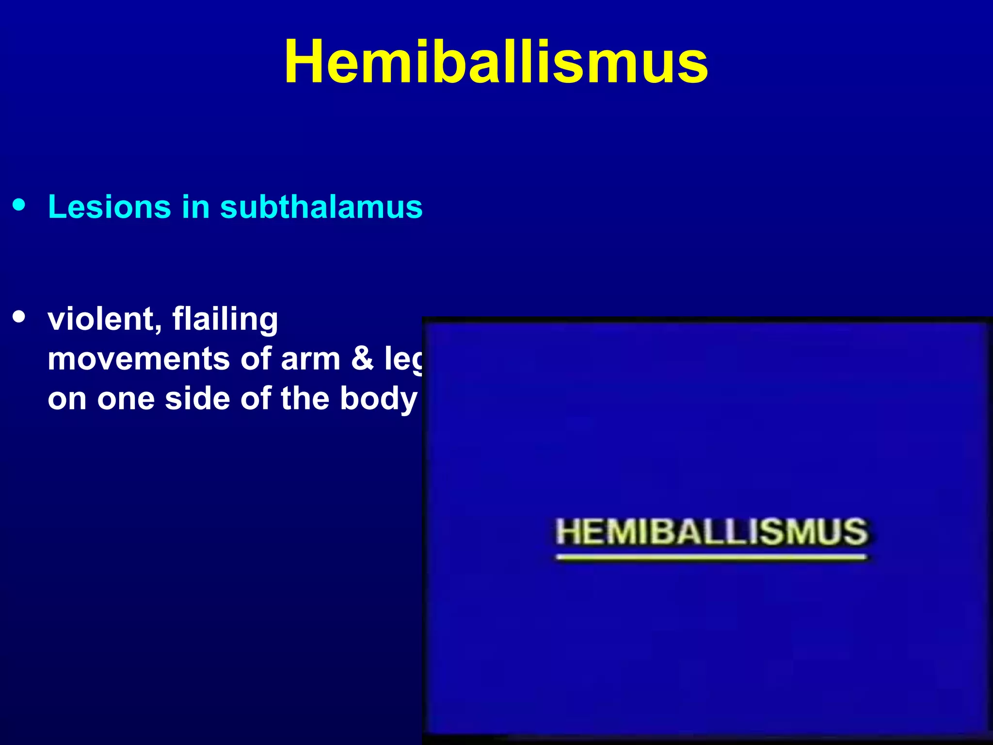 Hemiballismus 
• Lesions in subthalamus 
• violent, flailing 
movements of arm & leg 
on one side of the body 
 