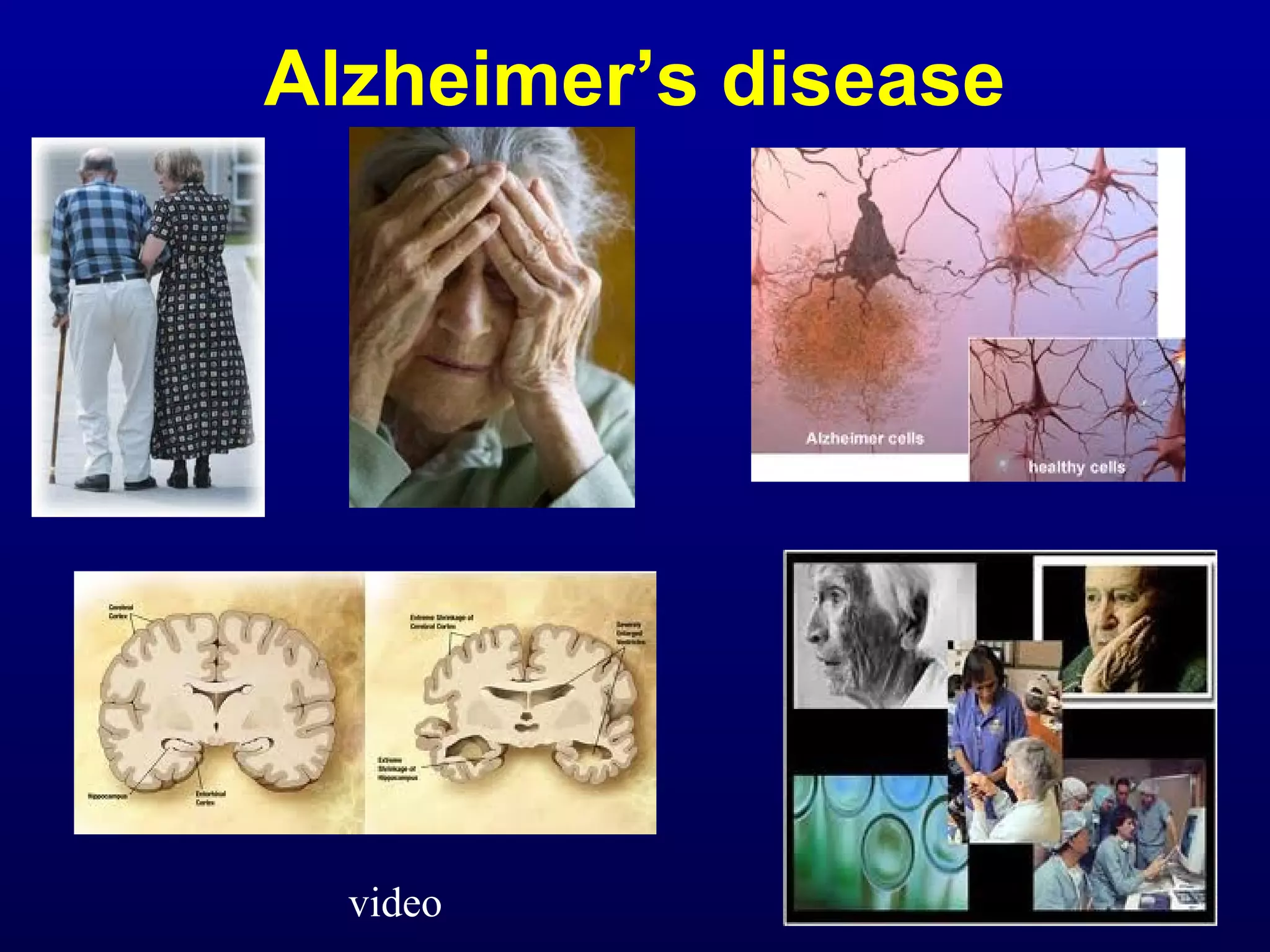 Alzheimer’s disease 
video 
 