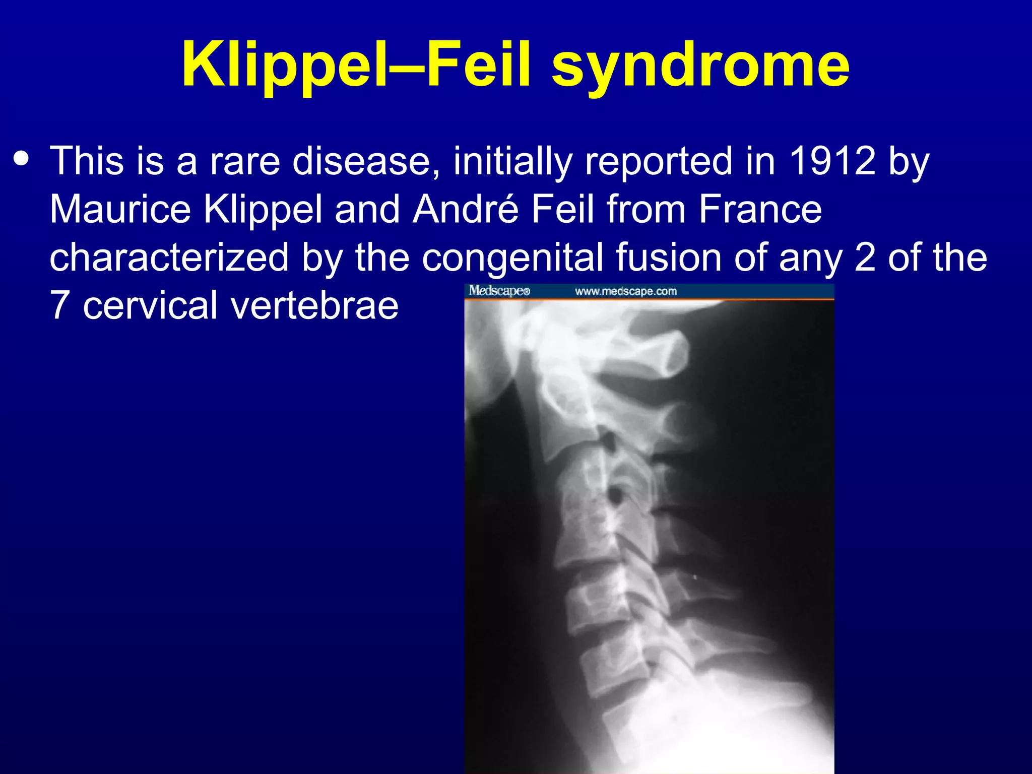 Klippel–Feil syndrome 
• This is a rare disease, initially reported in 1912 by 
Maurice Klippel and André Feil from France 
characterized by the congenital fusion of any 2 of the 
7 cervical vertebrae 
