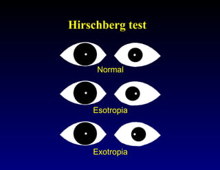 Hirschberg Test Normal Clinical Assessment of Strabismus and evaluation technique | PPT