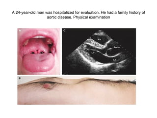A 24-year-old man was hospitalized for evaluation. He had a family history of aortic disease. Physical examination 