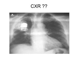CXR ?? 