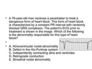 A 76-year-old man receives a pacemaker to treat a dangerous form of heart block. This form of heart block is characterized by a constant PR interval with randomly blocked QRS complexes. The patient’s ECG prior to treatment is shown in the image. Which of the following is the abnormality responsible for this type of heart block? A. Atrioventricular nodal abnormality B. Defect in the His-Purkinje system C. Independently contracting atria and ventricles D. Retrograde conduction E. Sinoatrial nodal abnormality 