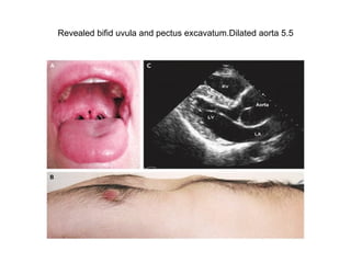 Revealed bifid uvula and pectus excavatum.Dilated aorta 5.5 
