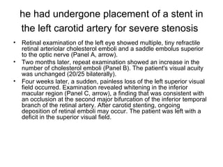 he had undergone placement of a stent in the left carotid artery for severe stenosis   Retinal examination of the left eye showed multiple, tiny refractile retinal arteriolar cholesterol emboli and a saddle embolus superior to the optic nerve (Panel A, arrow).  Two months later, repeat examination showed an increase in the number of cholesterol emboli (Panel B). The patient's visual acuity was unchanged (20/25 bilaterally).  Four weeks later, a sudden, painless loss of the left superior visual field occurred. Examination revealed whitening in the inferior macular region (Panel C, arrow), a finding that was consistent with an occlusion at the second major bifurcation of the inferior temporal branch of the retinal artery. After carotid stenting, ongoing deposition of retinal emboli may occur. The patient was left with a deficit in the superior visual field.  