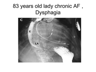 83 years old lady chronic AF , Dysphagia 