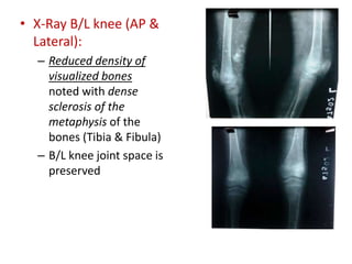 • X-Ray B/L knee (AP &
Lateral):
– Reduced density of
visualized bones
noted with dense
sclerosis of the
metaphysis of the
bones (Tibia & Fibula)
– B/L knee joint space is
preserved
 