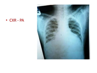 • CXR - PA
 