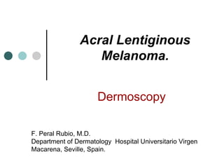 Acral Lentiginous Melanoma. Dermoscopy F. Peral Rubio, M.D. Department of Dermatology  Hospital Universitario Virgen Macarena, Seville, Spain. 