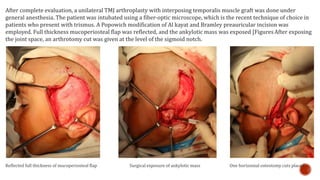 After complete evaluation, a unilateral TMJ arthroplasty with interposing temporalis muscle graft was done under
general anesthesia. The patient was intubated using a fiber-optic microscope, which is the recent technique of choice in
patients who present with trismus. A Popowich modification of Al kayat and Bramley preauricular incision was
employed. Full thickness mucoperiosteal flap was reflected, and the ankylotic mass was exposed [FiguresAfter exposing
the joint space, an arthrotomy cut was given at the level of the sigmoid notch.
Reflected full thickness of mucoperiosteal flap Surgical exposure of ankylotic mass One horizontal osteotomy cuts placed
 