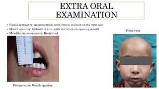 EXTRA ORAL
EXAMINATION
 Facial symmetry: Asymmetrical with fullness of cheek on the right side
 Mouth opening: Reduced 5 mm, with deviation on opening mouth
 Mandibular movements: Restricted
Preoperative Mouth opening
Front view
 