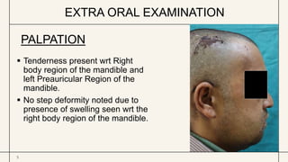 EXTRA ORAL EXAMINATION
5
 Tenderness present wrt Right
body region of the mandible and
left Preauricular Region of the
mandible.
 No step deformity noted due to
presence of swelling seen wrt the
right body region of the mandible.
PALPATION
 