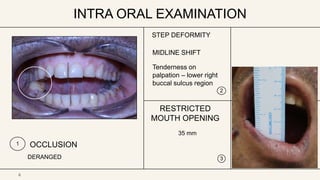 INTRA ORAL EXAMINATION
1 OCCLUSION
DERANGED
STEP DEFORMITY
2
RESTRICTED
MOUTH OPENING
35 mm
3
6
MIDLINE SHIFT
Tenderness on
palpation – lower right
buccal sulcus region
 
