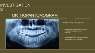 INVESTIGATION
S
ORTHOPANTOMOGRAM
The OPG findings are suggestive of –
- Horizontally Unfavorable Fracture of
the Right Body Region of the
mandible,
- Displaced Fracture Left Low Condylar
Neck Region of the mandible.
7
 
