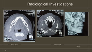 3D CT
8
NCCT FACE
NCCT FACE
Radiological Investigations
 