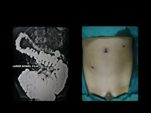Clinical case asr laparoscopic ladd's procedure for malrotation correction