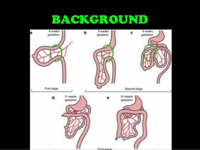 Clinical case asr laparoscopic ladd's procedure for malrotation corre…