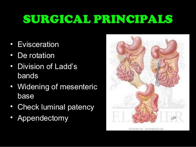 Clinical case asr laparoscopic ladd's procedure for malrotation corre…