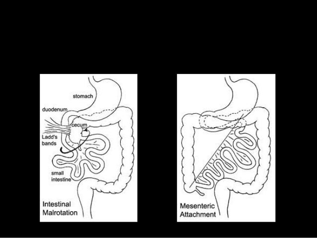 Clinical case asr laparoscopic ladd's procedure for malrotation corre…
