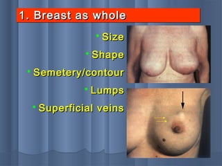 1. Breast as whole1. Breast as whole1. Breast as whole1. Breast as whole
 SizeSize
 ShapeShape
 Semetery/contourSemetery/contour
 LumpsLumps
 Superficial veinsSuperficial veins
 