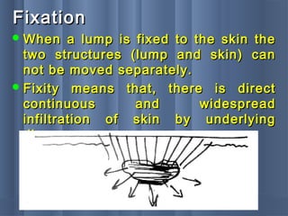 FixationFixation
 When a lump is fixed to the skin theWhen a lump is fixed to the skin the
two structures (lump and skin) cantwo structures (lump and skin) can
not be moved separately.not be moved separately.
 Fixity means that, there is directFixity means that, there is direct
continuous and widespreadcontinuous and widespread
infiltration of skin by underlyinginfiltration of skin by underlying
disease.disease.
 