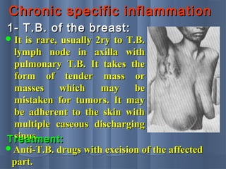 Chronic specific inflammationChronic specific inflammation
1- T.B. of the breast:1- T.B. of the breast:
 It is rare, usually 2ry to T.B.It is rare, usually 2ry to T.B.
lymph node in axilla withlymph node in axilla with
pulmonary T.B. It takes thepulmonary T.B. It takes the
form of tender mass orform of tender mass or
masses which may bemasses which may be
mistaken for tumors. It maymistaken for tumors. It may
be adherent to the skin withbe adherent to the skin with
multiple caseous dischargingmultiple caseous discharging
sinus.sinus.Treatment:Treatment:
Anti-T.B. drugs with excision of the affectedAnti-T.B. drugs with excision of the affected
part.part.
 