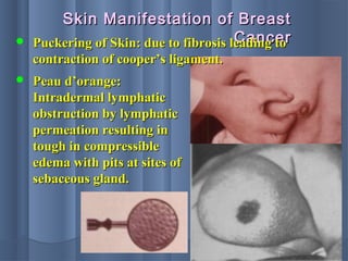 Skin Manifestation of BreastSkin Manifestation of Breast
CancerCancer
 Peau d’orange:Peau d’orange:
Intradermal lymphaticIntradermal lymphatic
obstruction by lymphaticobstruction by lymphatic
permeation resulting inpermeation resulting in
tough in compressibletough in compressible
edema with pits at sites ofedema with pits at sites of
sebaceous gland.sebaceous gland.
 Puckering of Skin: due to fibrosis leading toPuckering of Skin: due to fibrosis leading to
contraction of cooper’s ligament.contraction of cooper’s ligament.
 