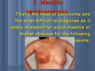 1. Mastitis1. Mastitis
carcinomatosacarcinomatosaThis is the most of carcinoma andThis is the most of carcinoma and
the most difficult to diagnose as itthe most difficult to diagnose as it
easily mistaken for acute mastitis oreasily mistaken for acute mastitis or
breast abscess for the followingbreast abscess for the following
reasons:reasons:
 