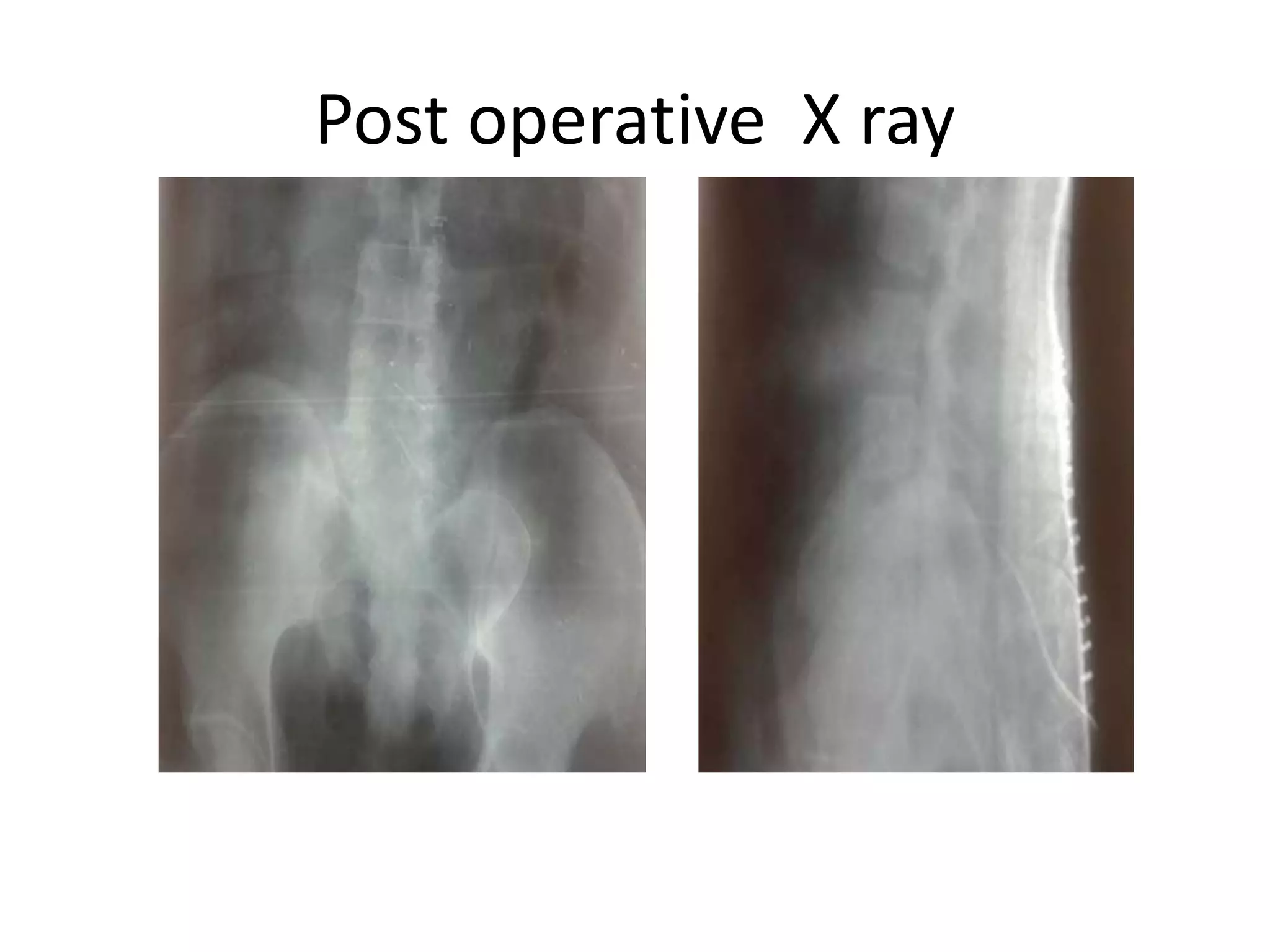 Post operative X ray
 