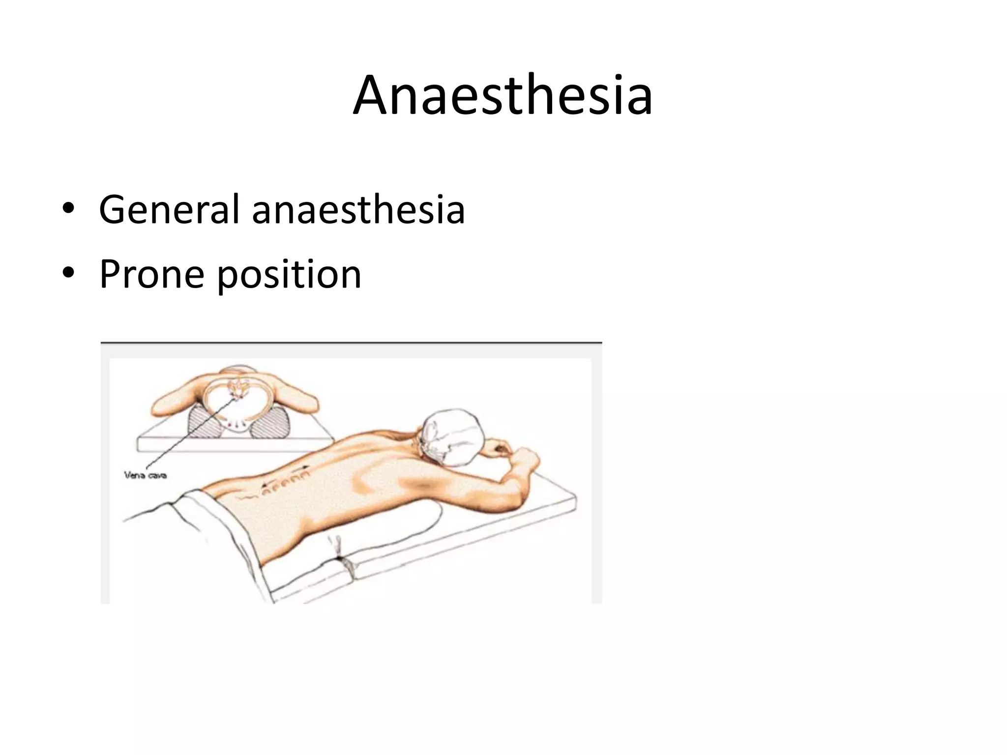 Anaesthesia
• General anaesthesia
• Prone position
 