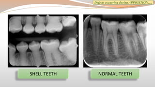 Clinical consideration in tooth development, eruption and shedding | PPTX