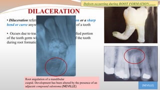 Sharp Linear Defect Tooth Clinical consideration in tooth development, eruption and shedding | PPTX