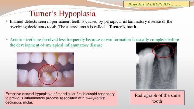 Clinical consideration in tooth development, eruption and 