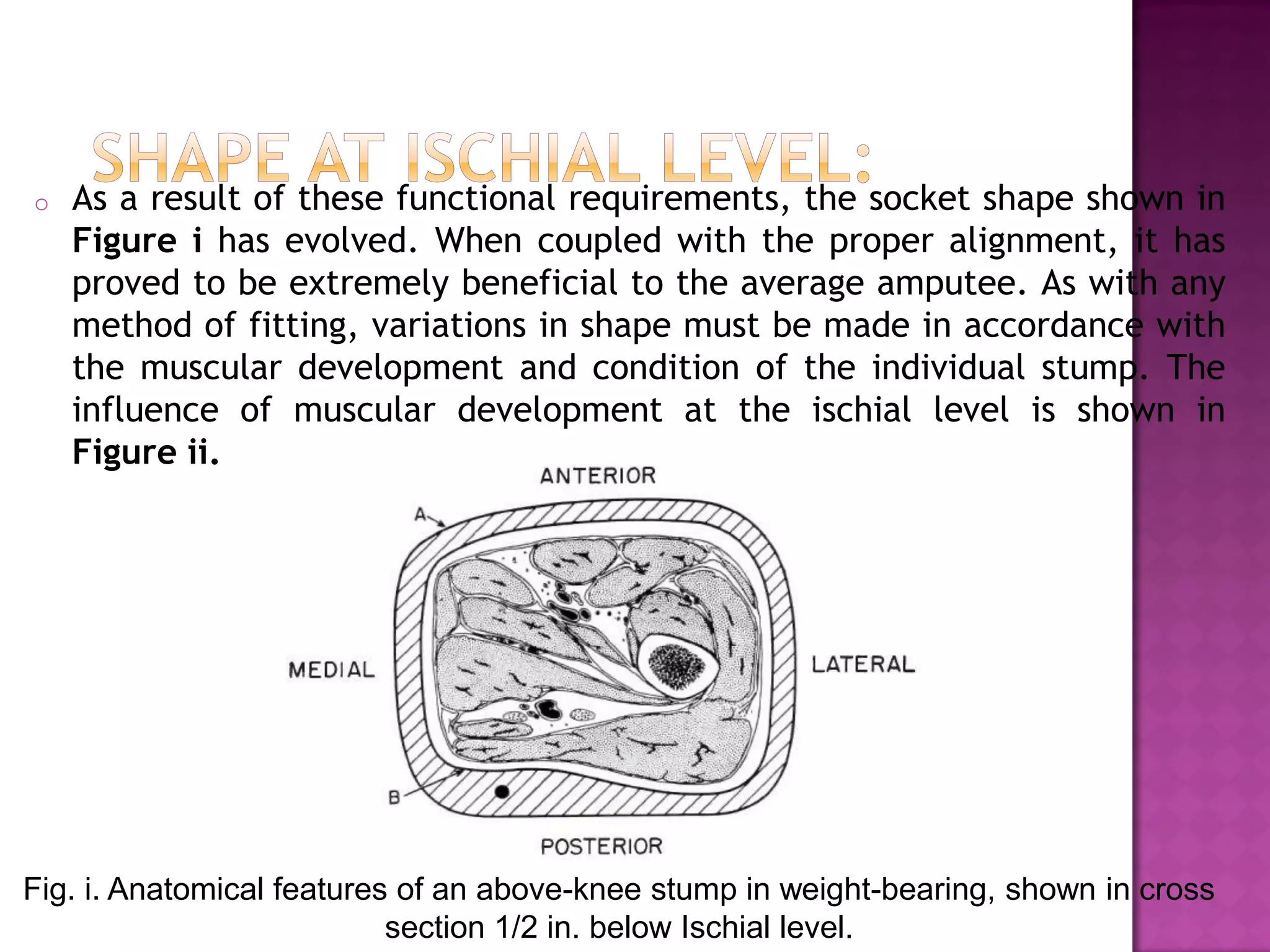 o As a result of these functional requirements, the socket shape shown in
Figure i has evolved. When coupled with the proper alignment, it has
proved to be extremely beneficial to the average amputee. As with any
method of fitting, variations in shape must be made in accordance with
the muscular development and condition of the individual stump. The
influence of muscular development at the ischial level is shown in
Figure ii.
Fig. i. Anatomical features of an above-knee stump in weight-bearing, shown in cross
section 1/2 in. below Ischial level.
 