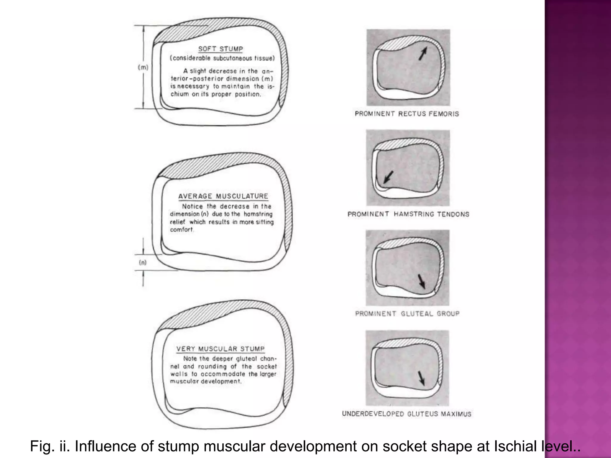 Fig. ii. Influence of stump muscular development on socket shape at Ischial level..
 