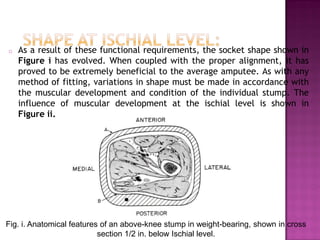 o As a result of these functional requirements, the socket shape shown in
Figure i has evolved. When coupled with the proper alignment, it has
proved to be extremely beneficial to the average amputee. As with any
method of fitting, variations in shape must be made in accordance with
the muscular development and condition of the individual stump. The
influence of muscular development at the ischial level is shown in
Figure ii.
Fig. i. Anatomical features of an above-knee stump in weight-bearing, shown in cross
section 1/2 in. below Ischial level.
 