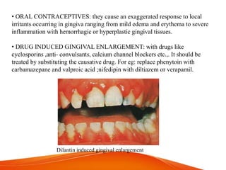 • ORAL CONTRACEPTIVES: they cause an exaggerated response to local
irritants occurring in gingiva ranging from mild edema and erythema to severe
inflammation with hemorrhagic or hyperplastic gingival tissues.
• DRUG INDUCED GINGIVAL ENLARGEMENT: with drugs like
cyclosporins ,anti- convulsants, calcium channel blockers etc.,. It should be
treated by substituting the causative drug. For eg: replace phenytoin with
carbamazepane and valproic acid ;nifedipin with diltiazem or verapamil.
Dilantin induced gingival enlargement
 