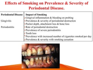 Effects of Smoking on Prevalence & Severity of
Periodontal Disease.
Periodontal Disease
Gingivitis
Periodontitis
Impact of Smoking
Gingival inflammation & bleeding on probing
Prevalence & severity of periodontal destruction
Pocket depth, attachment loss & bone loss
Rate of periodontal destruction
Prevalence of severe periodontitis
Tooth loss
Prevalence with increased number of cigarettes smoked per day
Prevalence & severity with smoking cessation
 