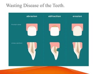 Wasting Disease of the Teeth.
 