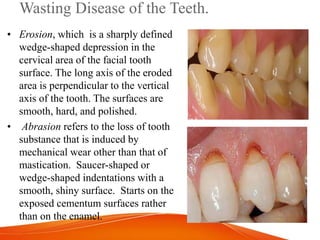 Wasting Disease of the Teeth.
• Erosion, which is a sharply defined
wedge-shaped depression in the
cervical area of the facial tooth
surface. The long axis of the eroded
area is perpendicular to the vertical
axis of the tooth. The surfaces are
smooth, hard, and polished.
• Abrasion refers to the loss of tooth
substance that is induced by
mechanical wear other than that of
mastication. Saucer-shaped or
wedge-shaped indentations with a
smooth, shiny surface. Starts on the
exposed cementum surfaces rather
than on the enamel.
 